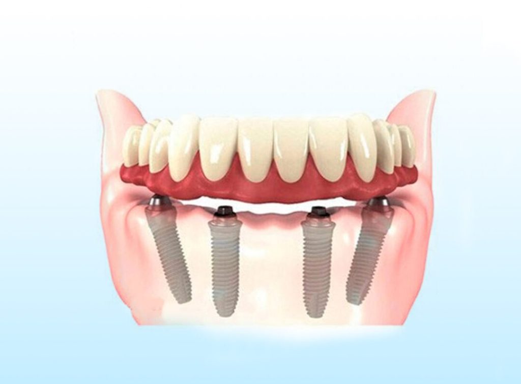 Ilustração de prótese total fixa sobre quatro implantes dentários no arco superior, técnica de reabilitação utilizada na Sorridents Porto Alegre.