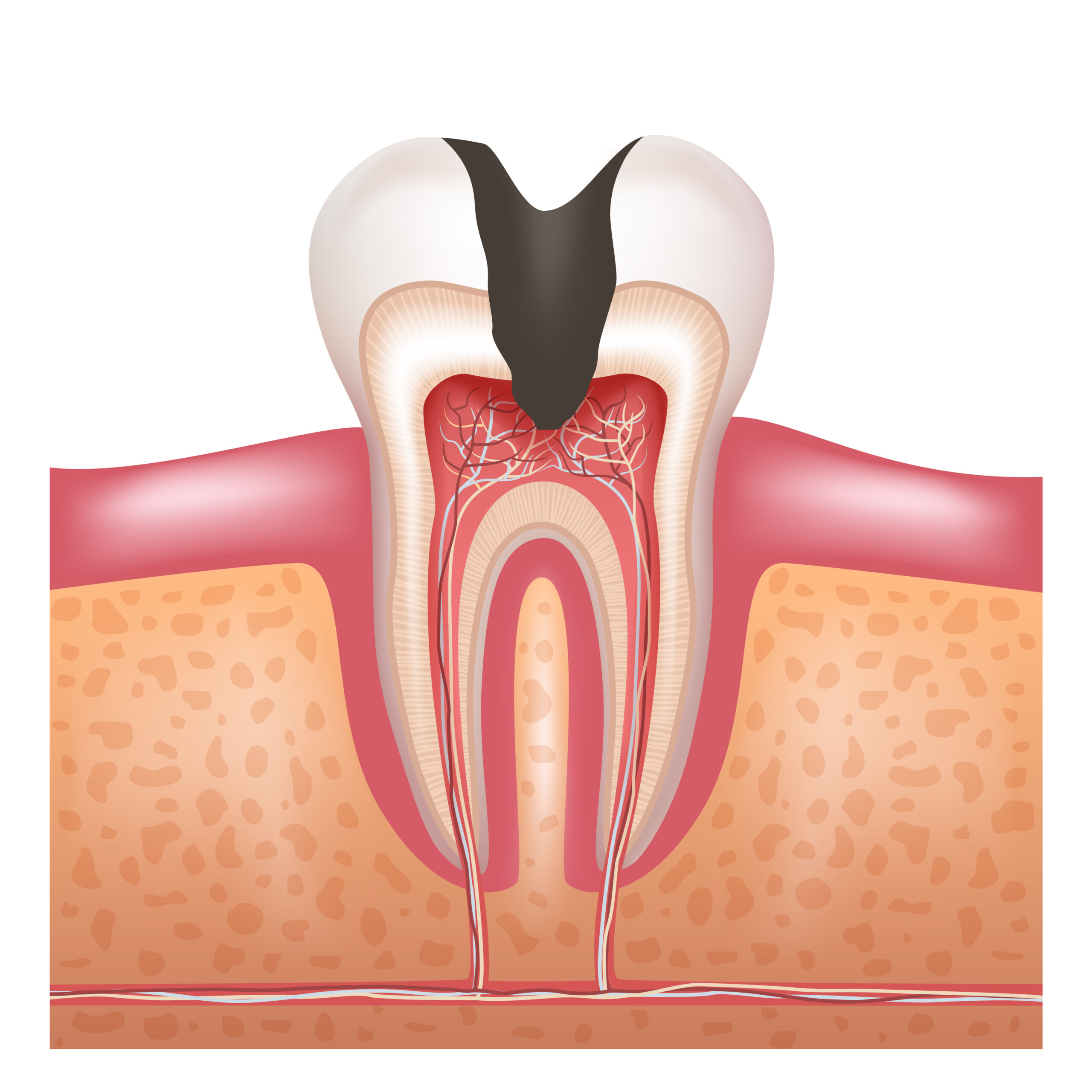 Ilustração de um dente com cárie profunda atingindo a polpa e os nervos, exigindo tratamento de canal, como feito na Sorridents Porto Alegre.