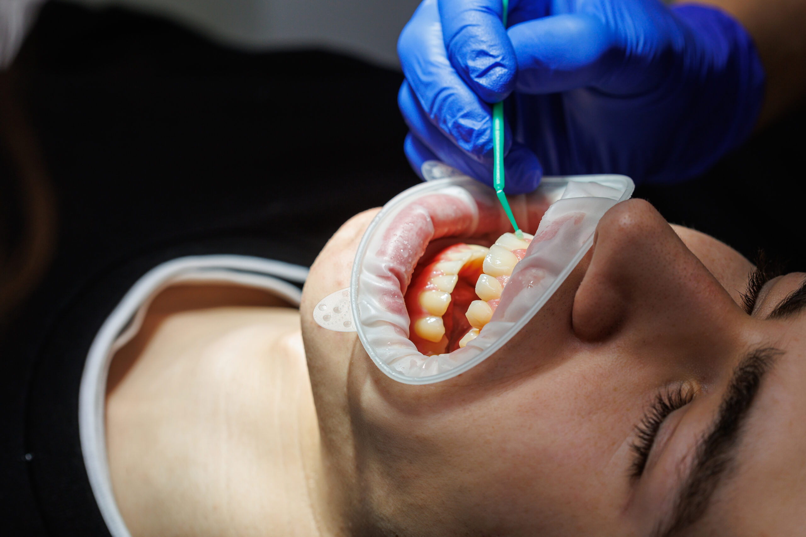 Aplicação de flúor nos dentes em consultório odontológico