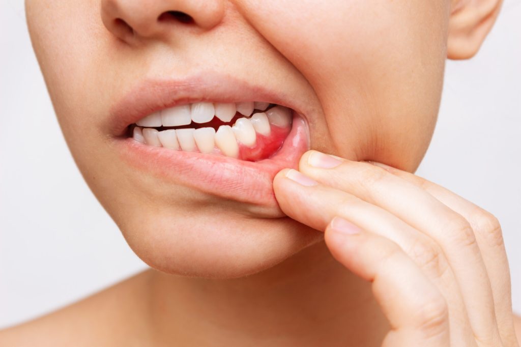Gengiva inflamada com sinais de doença gengival em paciente da Sorridents Porto Alegre