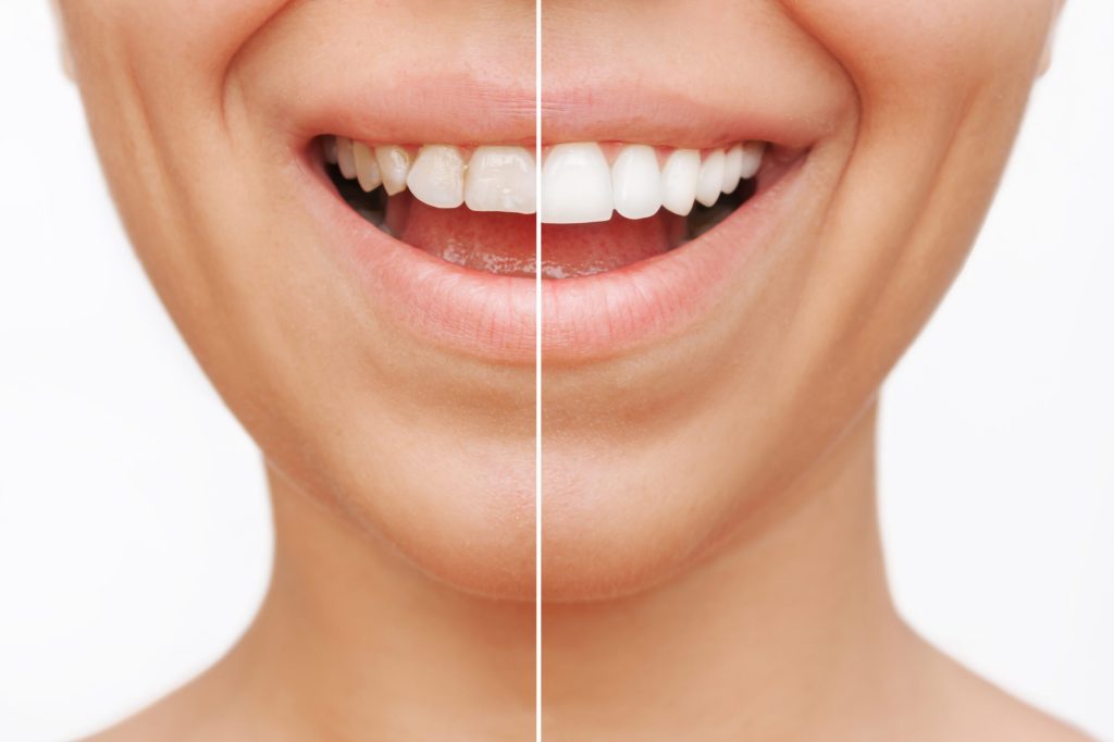 Antes e depois do sorriso com facetas dentárias aplicadas na Sorridents Porto Alegre