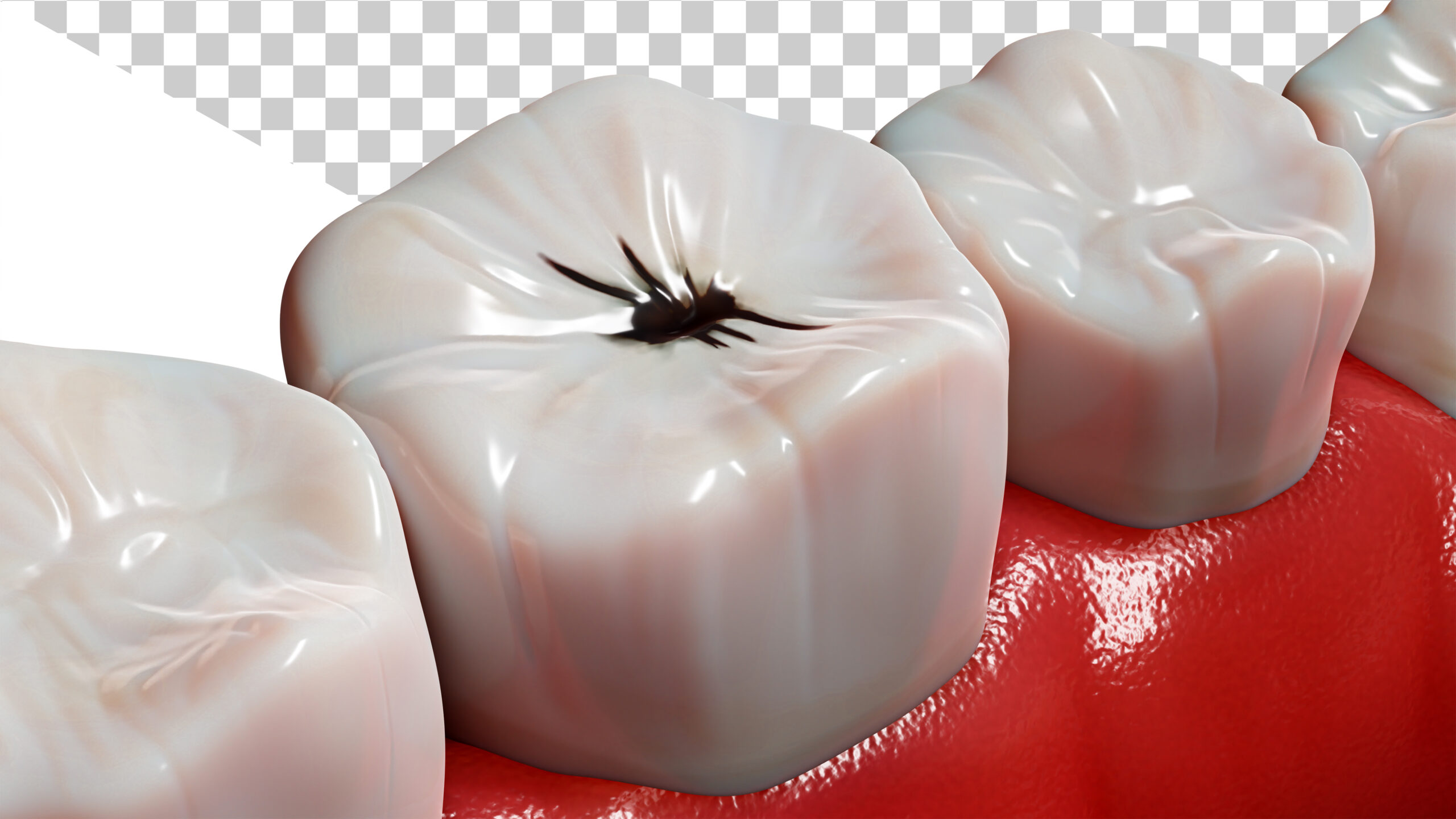 Dente com cárie em imagem ilustrativa mostrando o início da deterioração