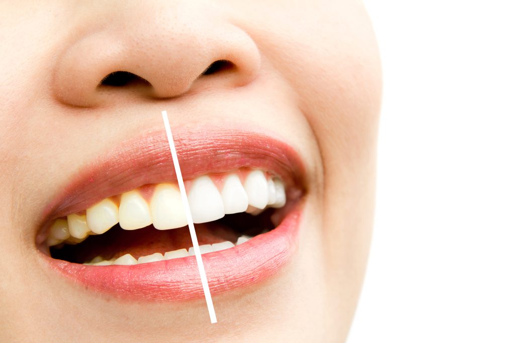 Comparação de antes e depois do clareamento dental, com dentes amarelados de um lado e brancos do outro, representando os resultados obtidos na Sorridents Porto Alegre.