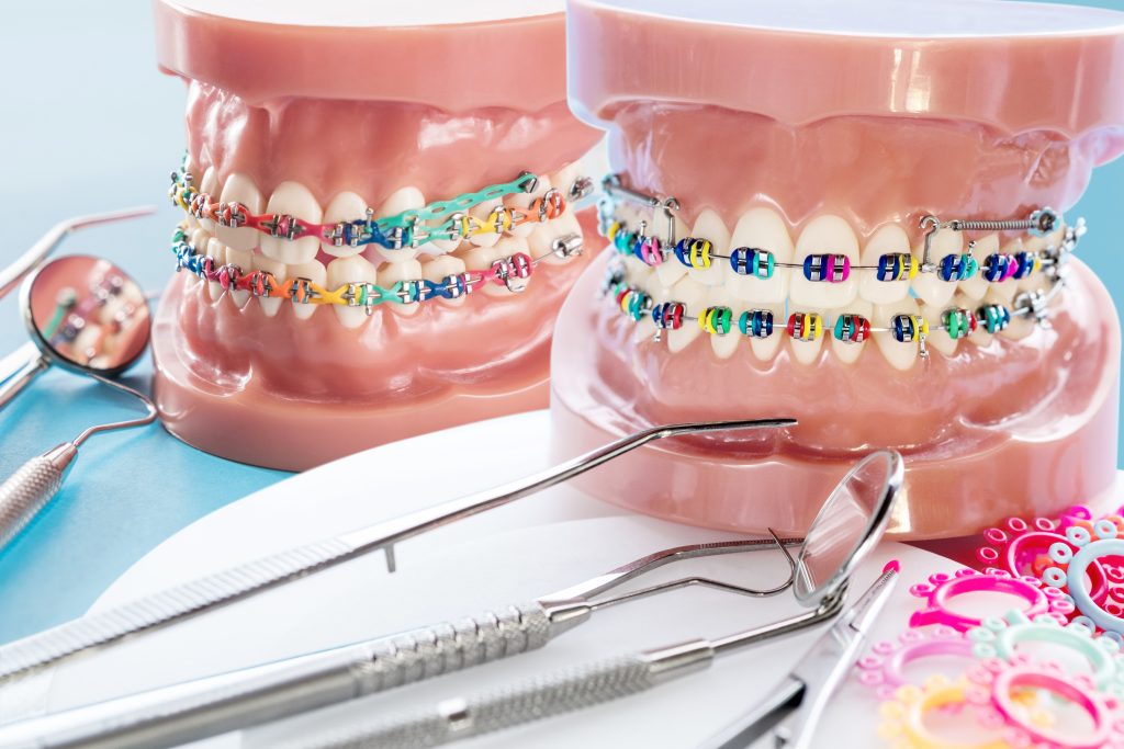 Modelos dentários com aparelhos metálicos e borrachinhas coloridas, usados em tratamentos ortodônticos da Sorridents Porto Alegre.