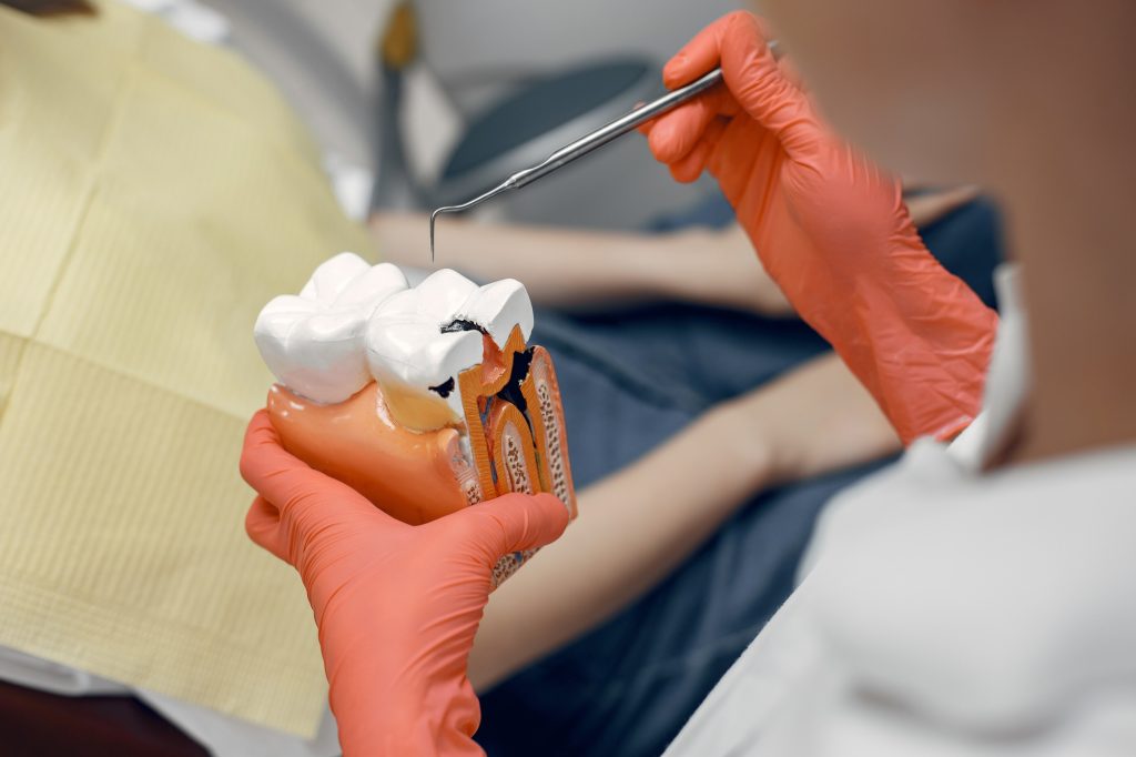 Dentista mostrando modelo de dente com cárie profunda para paciente