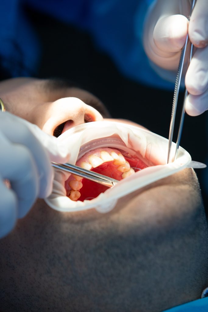 Paciente em atendimento odontológico com instrumentos cirúrgicos durante procedimento de extração dentária