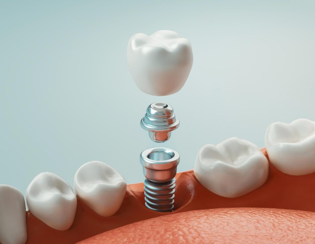 Ilustração em 3D das partes de um implante dentário, com pino metálico, abutment e coroa, usada para explicar o tratamento realizado na clínica Sorridents Porto Alegre.