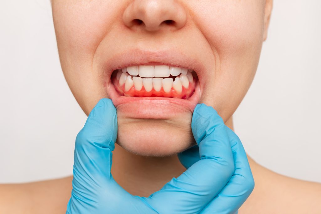 Paciente com gengivite apresentando vermelhidão e inflamação gengival, em exame na Sorridents Porto Alegre.