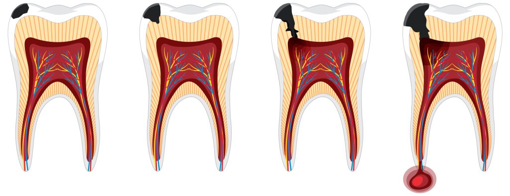 Ilustração dos quatro estágios da cárie, do esmalte à raiz, destacando a importância do tratamento odontológico na Sorridents Porto Alegre.