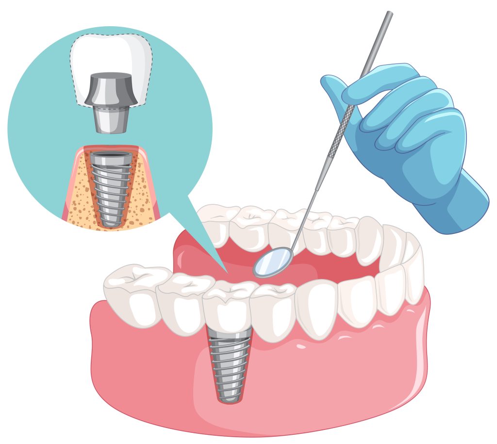 Ilustração de implante dentário com estrutura interna e coroa