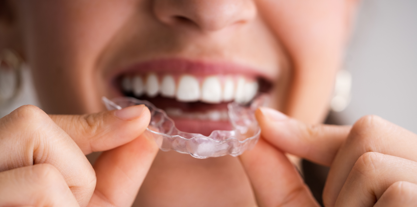 Mulher sorrindo enquanto posiciona uma placa de bruxismo nos dentes