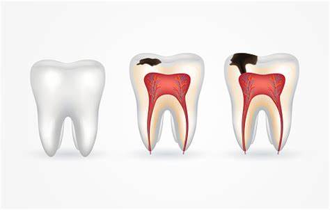 Progressão das cáries dentárias Ilustração mostrando a evolução da cárie dentária desde um dente saudável até um dente com infecção avançada.