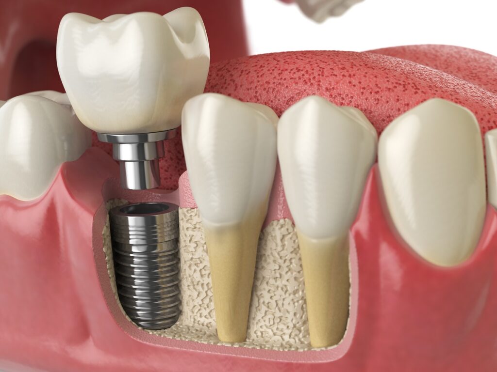 Ilustração de implante dentário integrado ao osso, com coroa finalizada