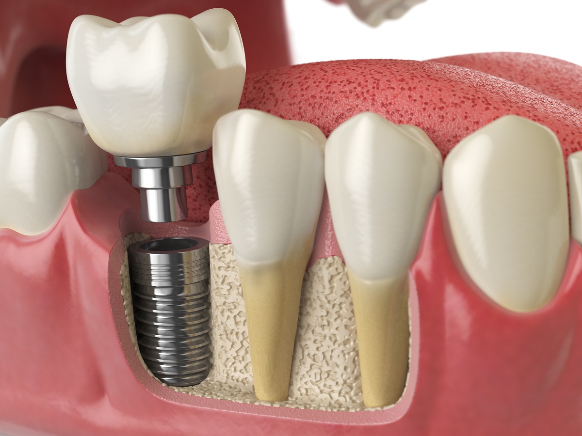 Ilustração de implante dentário integrado ao osso, com coroa finalizada