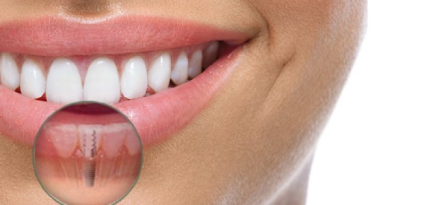Implante dentário ilustrado com sorriso natural Sorriso feminino com implante dentário em destaque em corte anatômico.